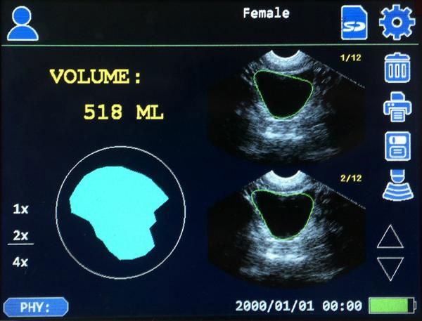 CareScan-1 ultrasound bladder scanner 3