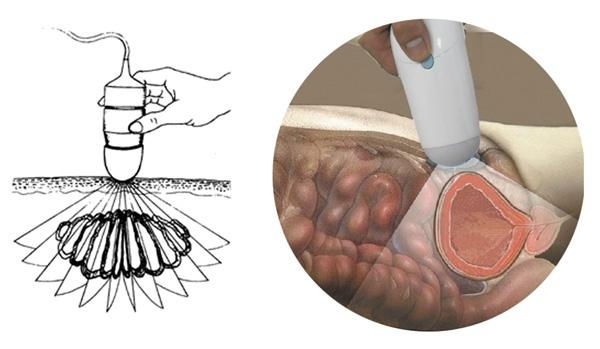 CareScan-1 ultrasound bladder scanner 5