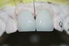 pfm crown/non precious pfm/pfm dental