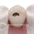 implant crown/dental implant/pfm implant