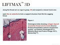 Amazing Anti-wrinkle LIFTMAX3D Cog Thread Implant 2