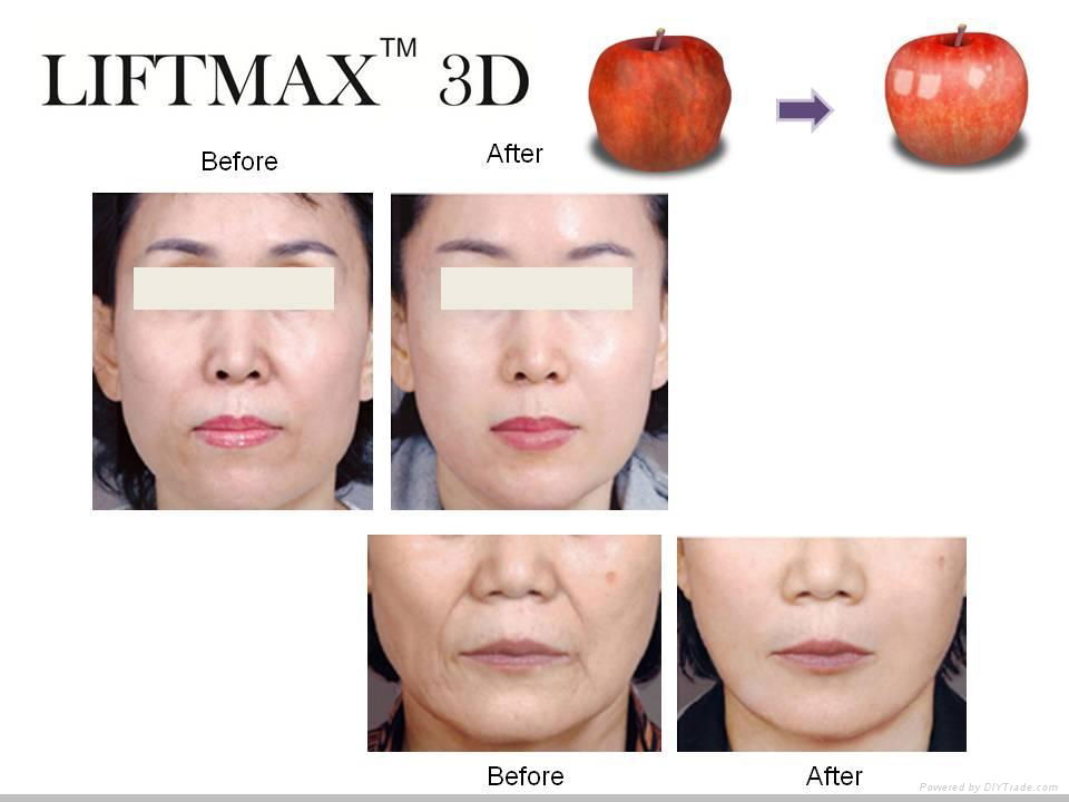 Amazing Anti-wrinkle LIFTMAX3D Cog Thread Implant 4