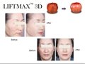 Amazing Anti-wrinkle LIFTMAX3D Cog Thread Implant 5