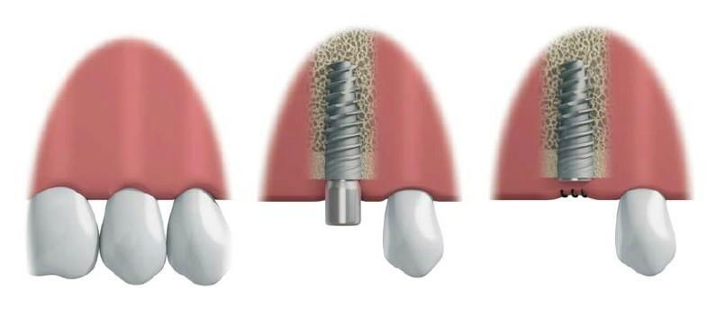 Titanium bars for dental implant 4