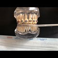Denxy Dental Orthodontic Bracket