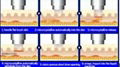 China supplier good effect rf machine/face lifting fractional microneedle device 3