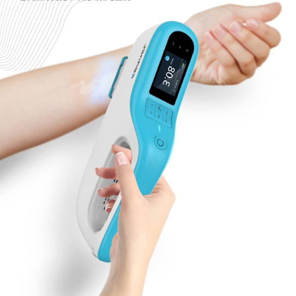 low cost good effect laser 308nm excimer lamp for vitiligo ,psoriasis  2