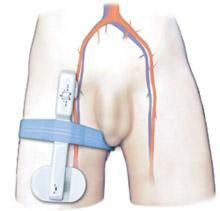 Goldfinger®Electronic Femoral Hemostasis Compression Device