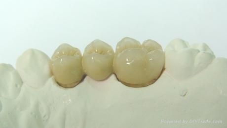 Dental PFM Crown - 1.1 (China Manufacturer) - Other Security