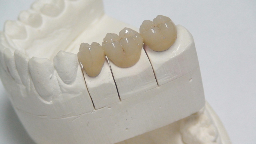 Dental PFM Crown - 1.1 (China Manufacturer) - Other Security