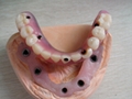 Partial Denture / RPD 5