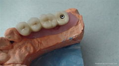 Implant PFM Crown & Bridge