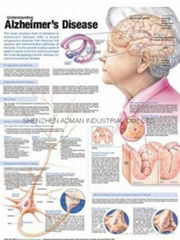 阿尔茨海默病三维立体PS/PET医学挂图/广告画