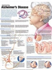 阿爾茨海默病三維立體PS/PET醫學挂圖/廣告畫