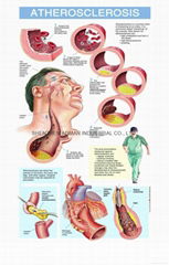 动脉粥样硬化---三维立体PS/PET医学挂图/广告画