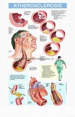 動脈粥樣硬化---三維立體PS/PET醫學挂圖/廣告畫