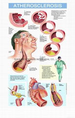 ATHEROSCLEROSIS--3D RELIEF WALL MEDICAL/PHARMA CHART/POSTER