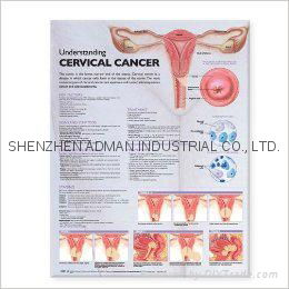 CERVICAL CANCER--3D RELIEF WALL MEDICAL/PHARMA CHART/POSTER