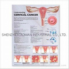 CERVICAL CANCER--3D RELIEF WALL MEDICAL/PHARMA CHART/POSTER