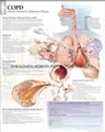 慢性阻塞性肺病(慢性阻塞性肺病