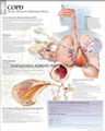 慢性阻塞性肺病(慢性阻塞性肺病)---三維立體PS/PET醫學挂圖/廣告畫