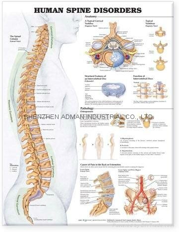 human spine disorders--3D RELIEF WALL MEDICAL/PHARMA CHART/POSTER