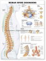 人类脊柱疾病---三维立体PS/PET医学挂图/广告画