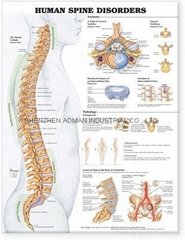 human spine disorders--3D RELIEF WALL MEDICAL/PHARMA CHART/POSTER
