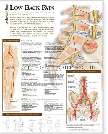 腰痛---三维立体PS/PET医学挂图/广告画 1