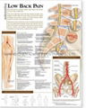 low back pain--3D RELIEF WALL MEDICAL/PHARMA CHART/POSTER