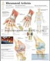 类风湿性关节炎---三维立体PS/PET医学挂图/广告画 1