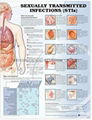 SEXUALLY TRANSMITTED INFECTIONS(STIs--3D RELIEF WALL MEDICAL/PHARMA CHART/POSTER 1