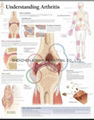 理解关节炎--三维立体PS/PET医学挂图/广告画 1