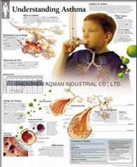 了解哮喘--三维立体PS/PET医学挂图/广告画