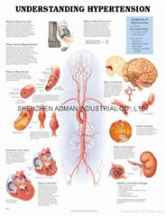 UNDERSTANDING HYPERTENSION--3D RELIEF WALL MEDICAL/PHARMA CHART/POSTER