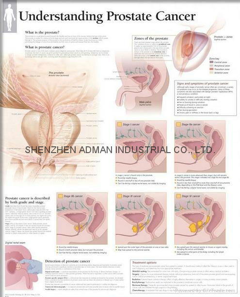 了解前列腺癌-三维立体PS/PET医学挂图/广告画