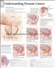 了解前列腺癌-三維立體PS/PET醫學挂圖/廣告畫