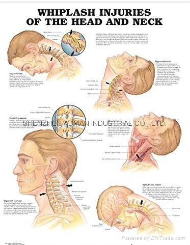 了解脑震荡（头部和颈部）-三维立体PS/PET医学挂图/广告画