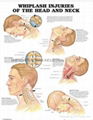 了解脑震荡（头部和颈部）-三维立体PS/PET医学挂图/广告画 1