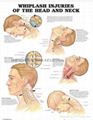 Whiplash Injuries of the Head and Nec-3D RELIEF WALL MEDICAL/PHARMA CHART/POSTER