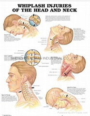 了解腦震盪（頭部和頸部）-三維立體PS/PET醫學挂圖/廣告畫