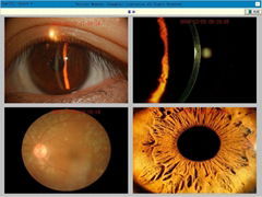 Digital imaging system for slit lamp microscope