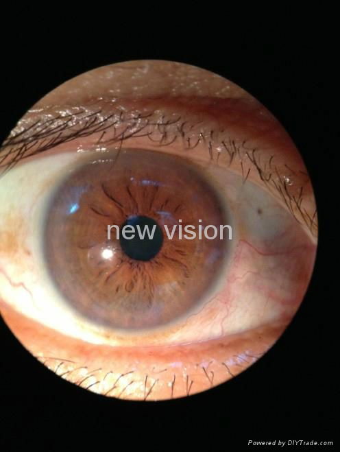 Slit Lamp Adapters turn Smartphones into Clinical Cameras 4