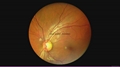 Portable  non-mydriatic Fundus Camera 5