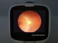 Digital Hand Held Fundus Camera  4