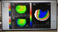 Corneal Topographer 5