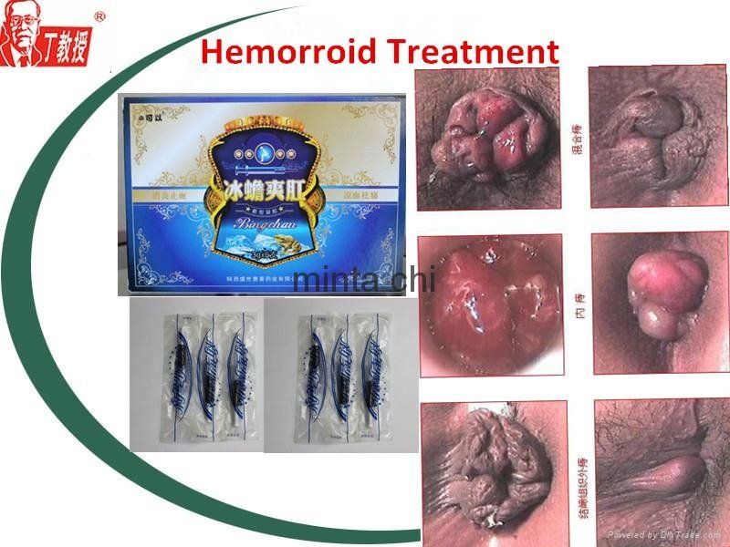 Hemorroides tratamiento natural