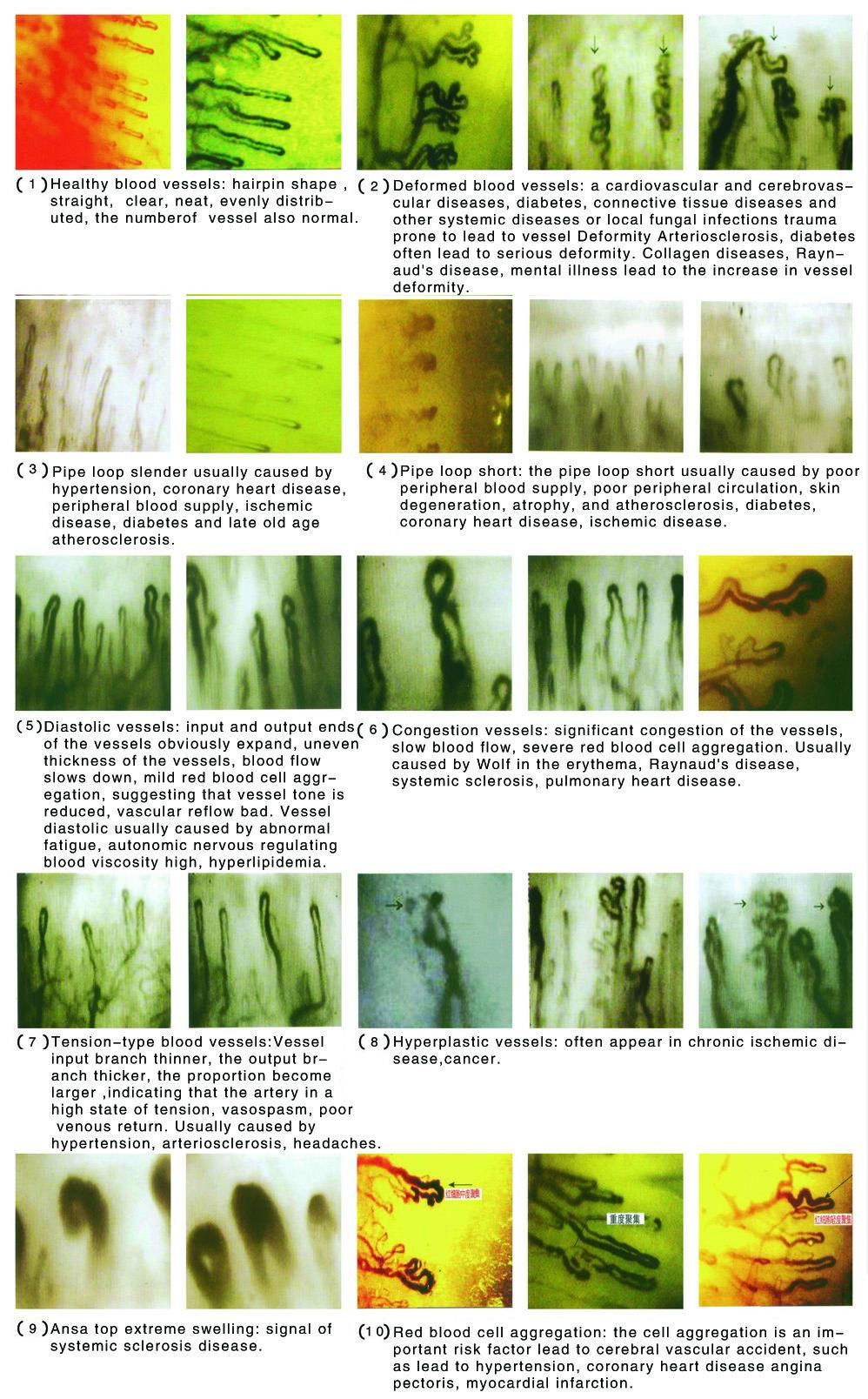 Portable Nail fold microcirculation microscope 4