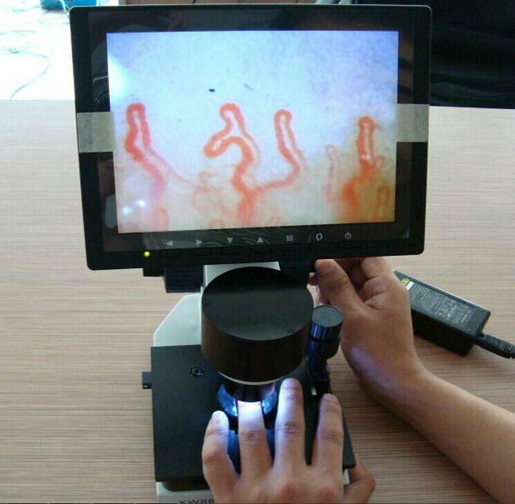 Portable Nail fold microcirculation microscope