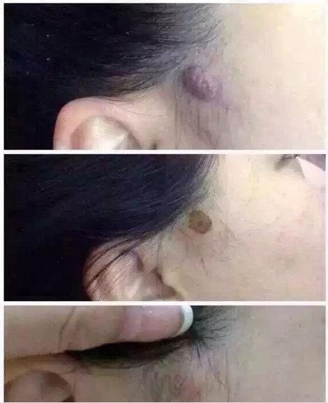 Best effective hot salon skin beauty laser CO2 spot removal pen freckle removal  3